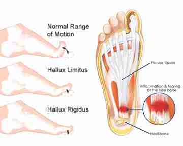 Foot pain in the morning or after rest?