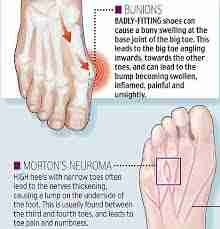 The dangers of wearing high heels