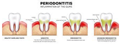 Maintaining healthy gums
