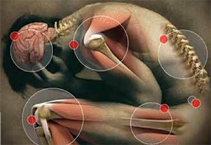 Managing  fibromyalgia