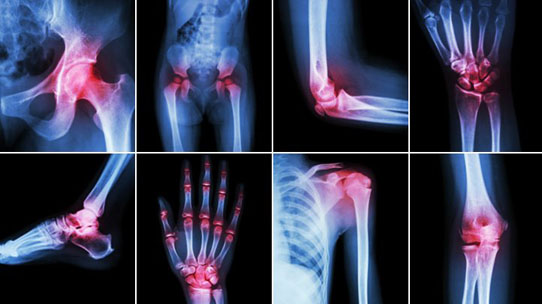 Managing  arthritis and joint pain