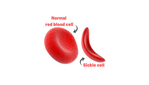 Managing sickle cell during pregnancy, childhood
