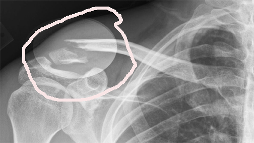 Protein problem slows down fracture-healing