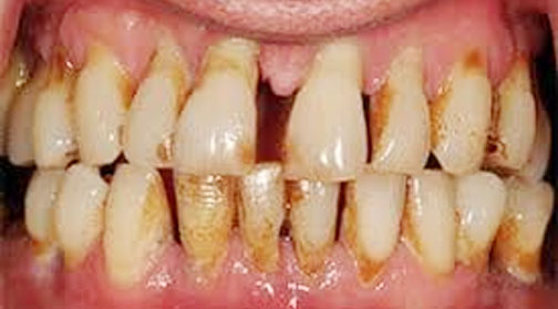 Gum disease linked to higher risk of hypertension