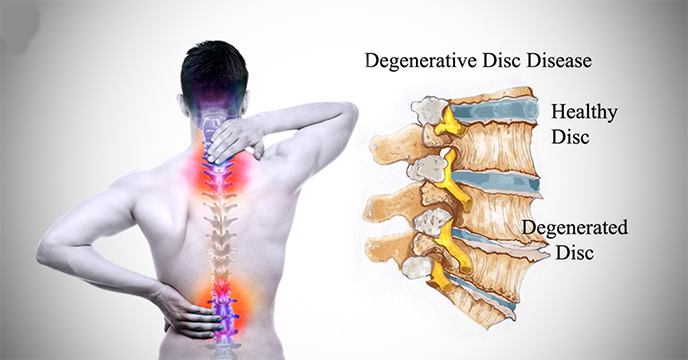 Help – I have degenerative disc disease in my spine!