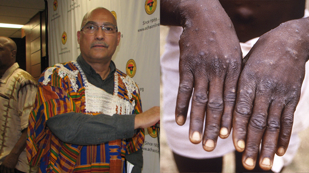 BSTF and Toronto Public Health Urge Black and Caribbean Community to Vaccinate Against Mpox